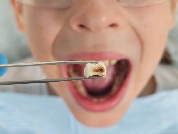 Best Emergency Root Canal Treatment in Pontotoc, MS